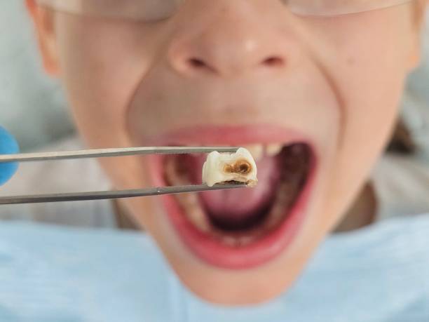 Best Emergency Dental Extractions in Cane Savannah, SC